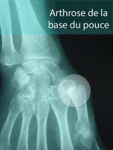 Arthrose-base-pouce-radiographie