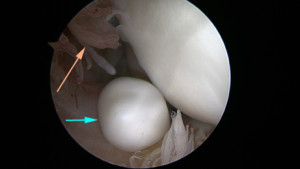 Corps libre intra articulaire  du coude (flèche bleue) chez un adolescent atteint d'ostéochondrite disséquante. La flèche orange indique des franges synoviales.