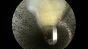 Vue endoscopique du canal carpien pendant l'intervention. On voit le ligament en haut (en blanc) et les parois de la canule métallique de chaque côté (en gris). Un instrument a été introduit dans le canal carpien et permet de palper le ligament. 
