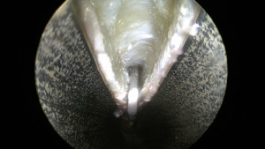 Ouverture du canal carpien par voie endoscopique. La canule métallique a été introduite à l'intérieur du canal. Le ligament est ouvert, les deux berges s'écartent et le nerf (non visible sur cette image) est libéré