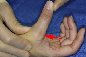 La flèche indique le siège de la rupture ligamentaire. 