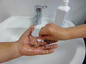 Le lavage sous l'eau courante permet d'éliminer les croûtes et de nettoyer la peau