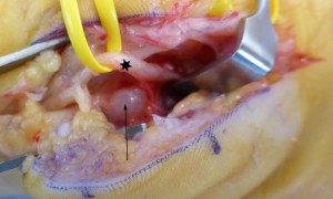 Ce nerf ulnaire était comprimé au poignet par un kyste synovial dans le canal de Guyon