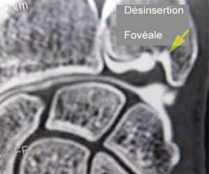Désinsertion du TFCC au niveau de la fovéa. Le produit de contraste passe entre le TFCC et son insertion osseuse.