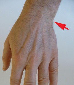 Les douleurs dues aux lésions du TFCC se situent du côté ulnaire du poignet