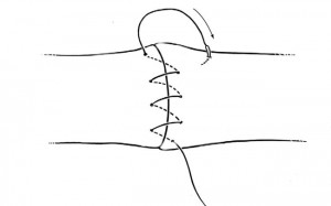 Le premier surjet est proche des berges de la plaie