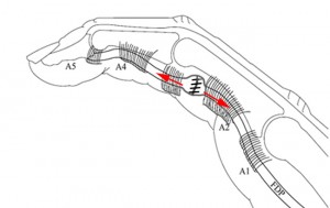 Après élargissement des poulies, la zone de suture coulisse à l'intérieur des poulies élargies.