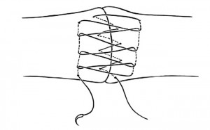 Le surjet de retour est un surjet passé, prenant le tendon plus largement.