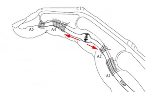 Après ouverture partielle des poulies, la suture coulisse mais le tendon prend un peu la corde.