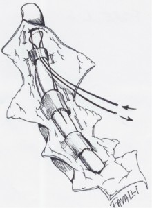 Le fil est passé autour du tendon profond à l'extrémité du doigt