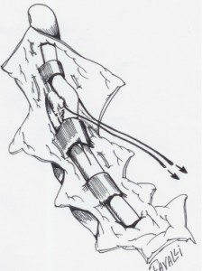 La traction sur le fil libère le tendon profond sous la dernière poulie