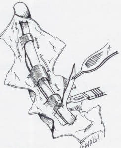 Une bandelette du fléchisseur superficiel est enlevée pour simplifier le croisement des deux tendons