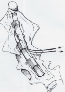 Le fils est passé sous la poulie suivante