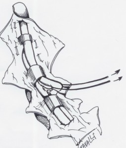 Le tendon profond est libéré jusqu'à la poulie suivante