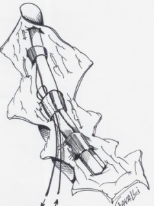 Le fil est passé autour du tendon superficiel