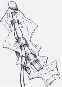 Les deux tendons sont complètement libérés sans ouverture des poulies.